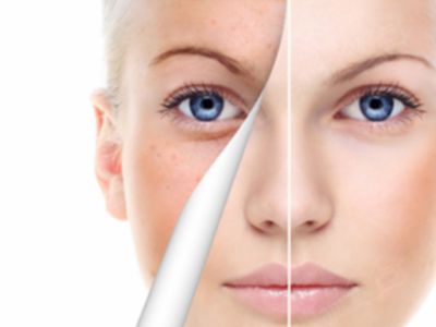 三七祛斑对比图 三七祛斑对比图